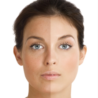 Changes in skin pigmentation, or “facial spotting,” have two major culprits: sun damage and aging.