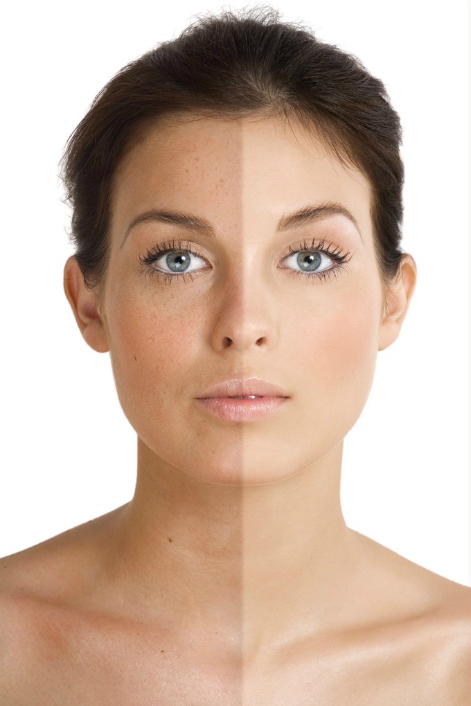 Changes in skin pigmentation, or “facial spotting,” have two major culprits: sun damage and aging.